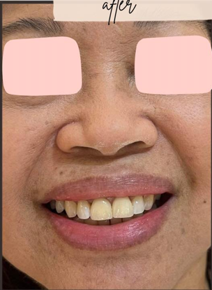 Whitening Result